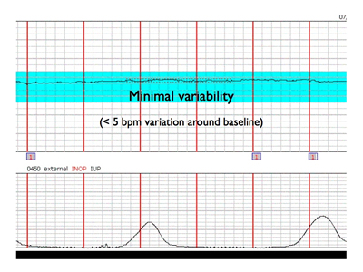 marked variability fetal heart rate